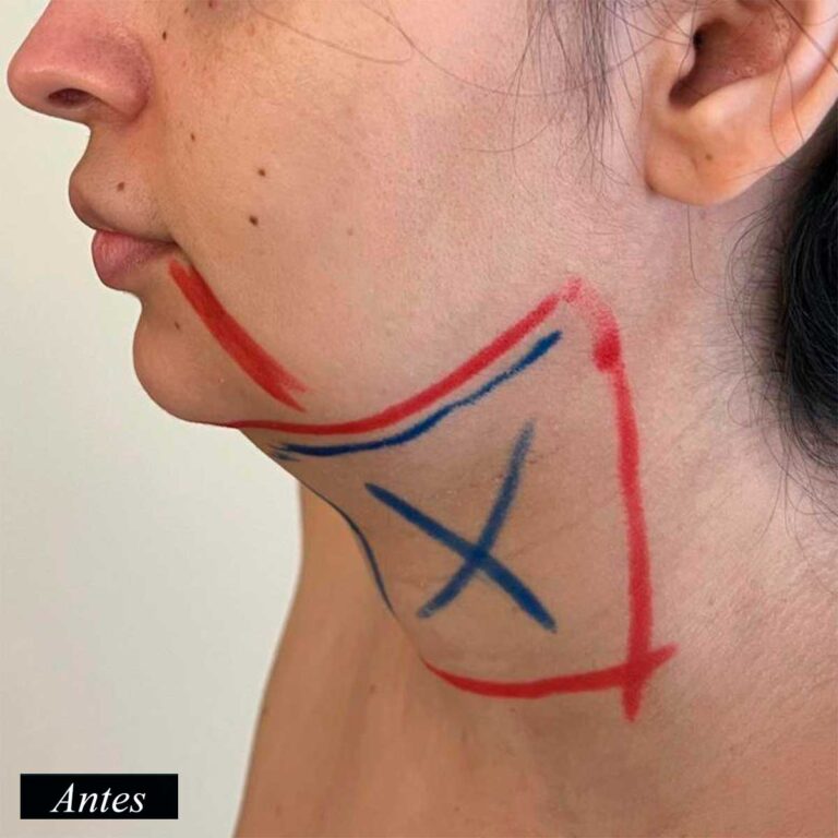 Antes de endolifting de papada