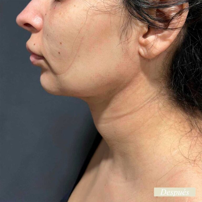 Despues de endolifting de papada