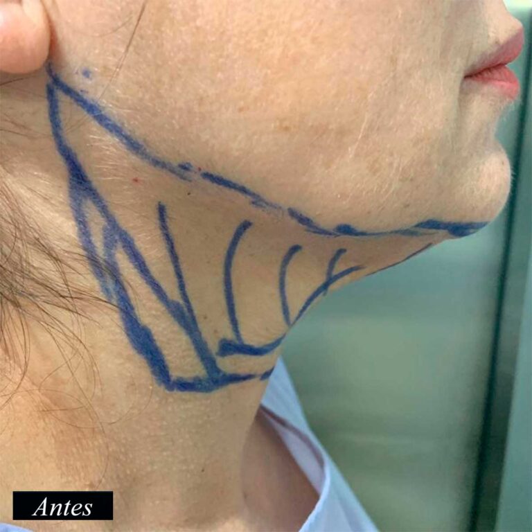 Antes de endolifting de papada