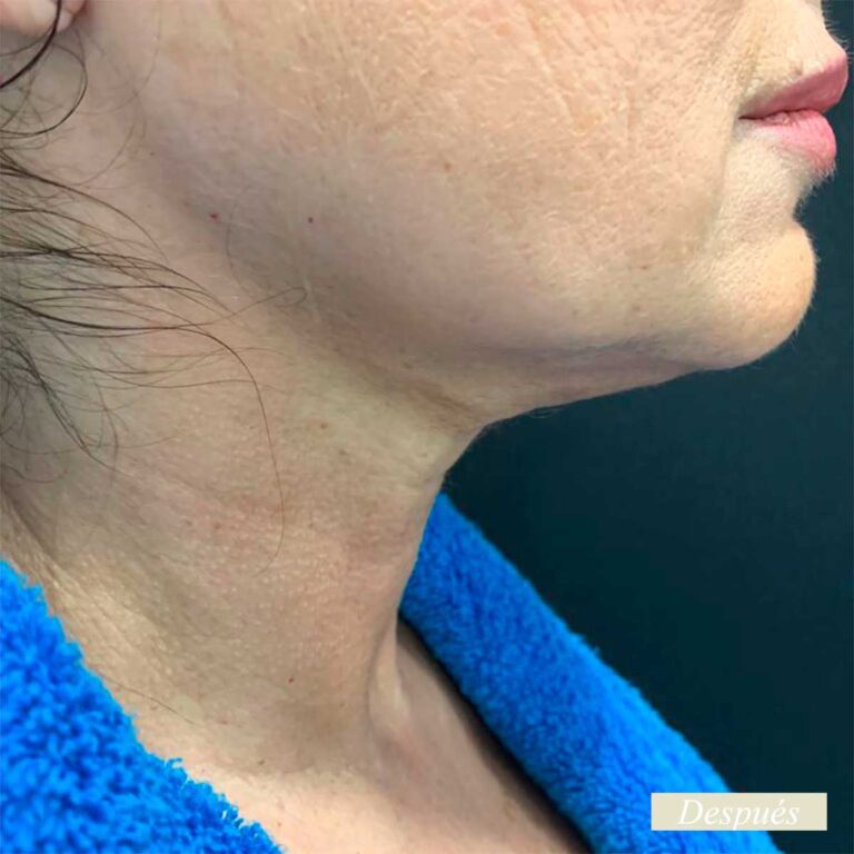 Despues de endolifting de papada