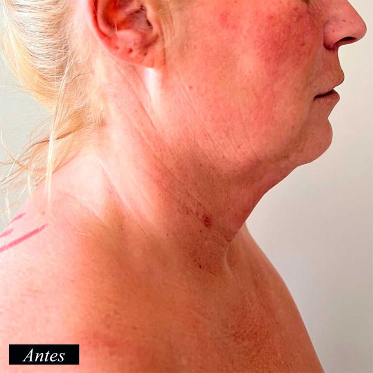 Antes de endolifting de papada