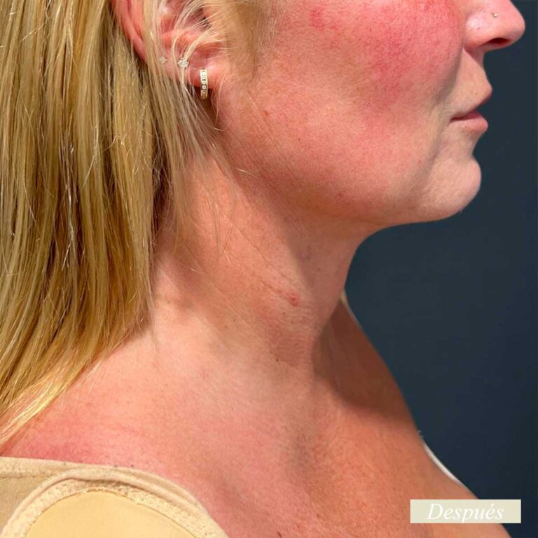 Despues de endolifting de papada