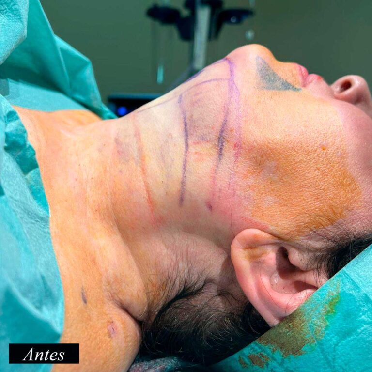 Antes de endolifting de papada