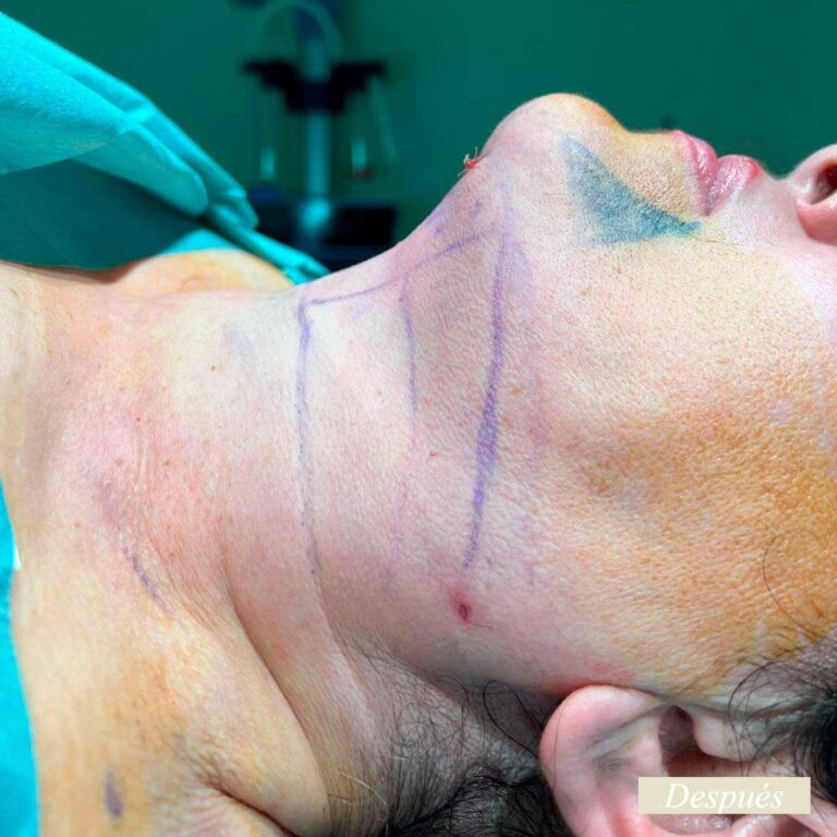 Despues de endolifting de papada