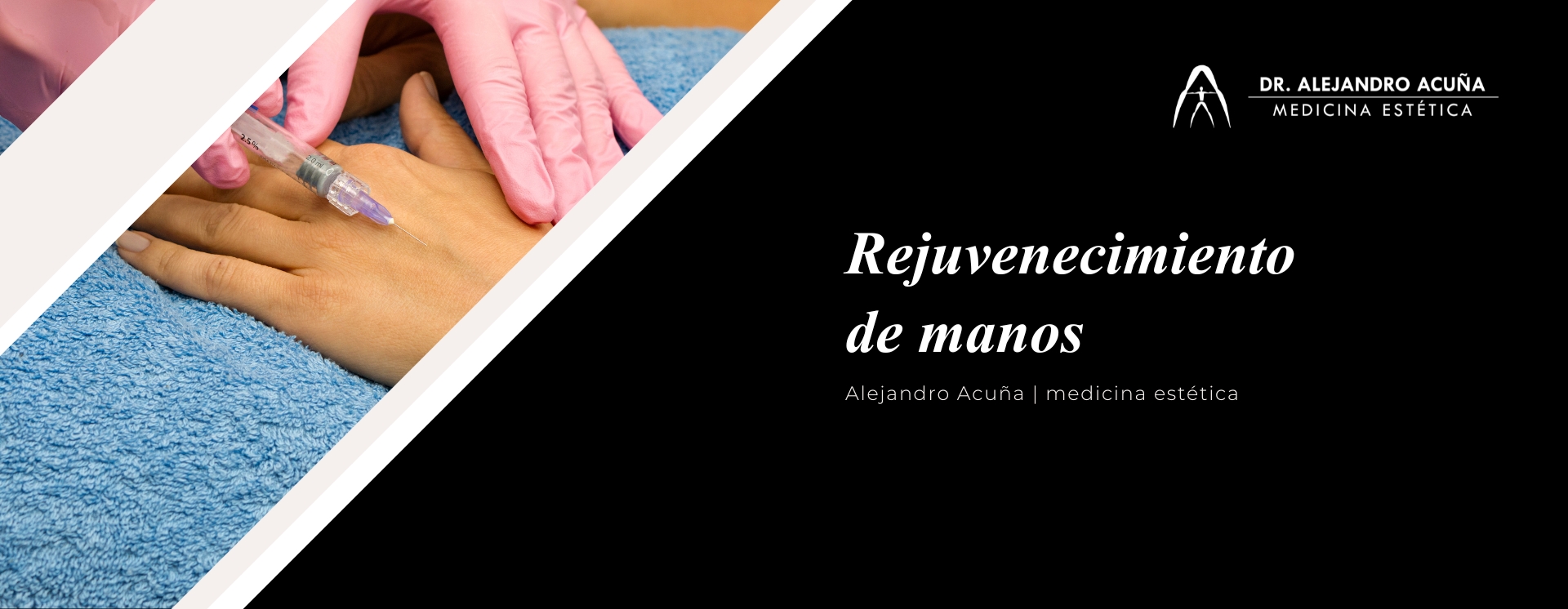 rejuvenecimiento de manos con inductores de colágeno