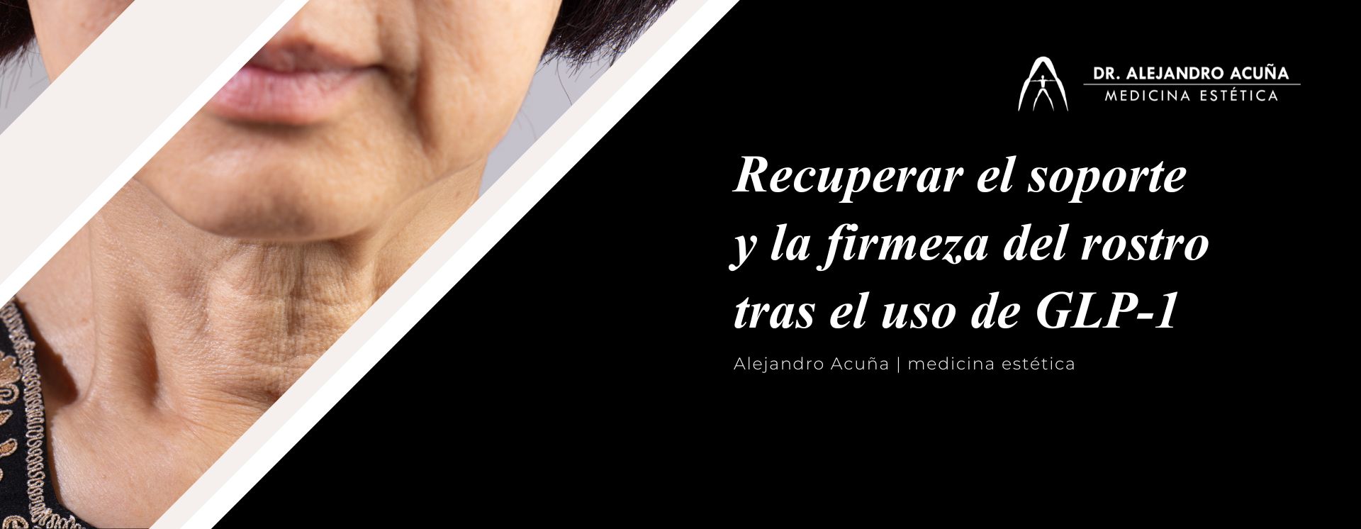 Rostro tras la pérdida de peso con GLP-1