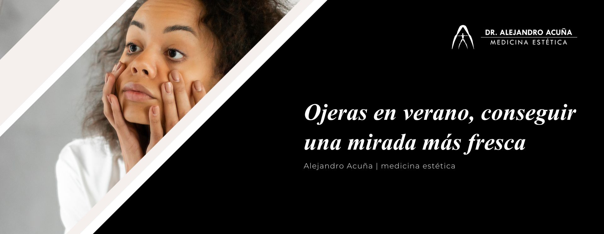 Ojeras en verano, causa y tratamiento