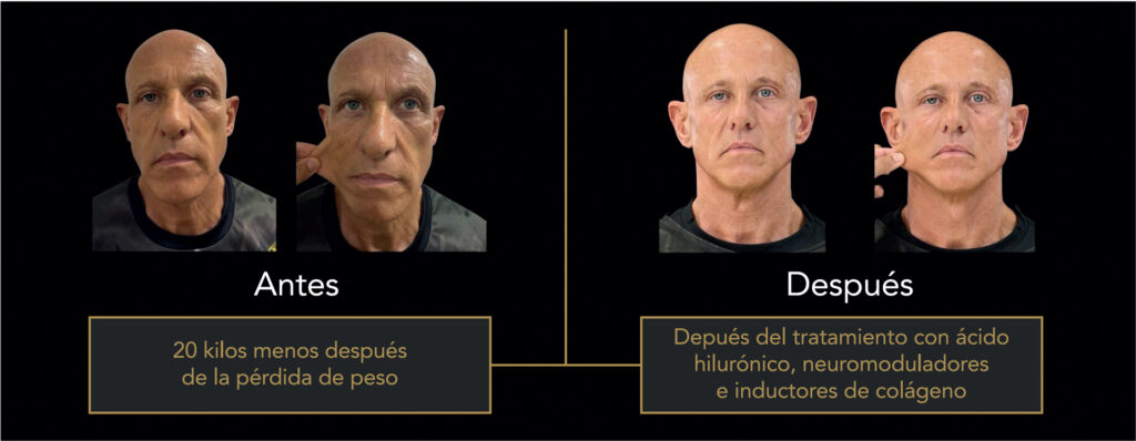 La otra cara de la pérdida de peso rápida con GLP-1: cómo recuperar el soporte y la firmeza del rostro 1 - Dr. Alejandro Acuña Antes y después del tratamiento de la flacidez facial por pérdida de peso en un paciente masculino de AA Clinic.
